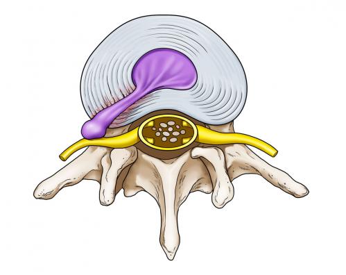 hernia-foraminal